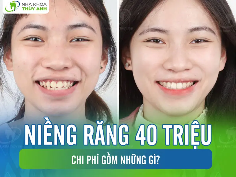 Niềng răng 40 triệu chi phí gồm những gì?