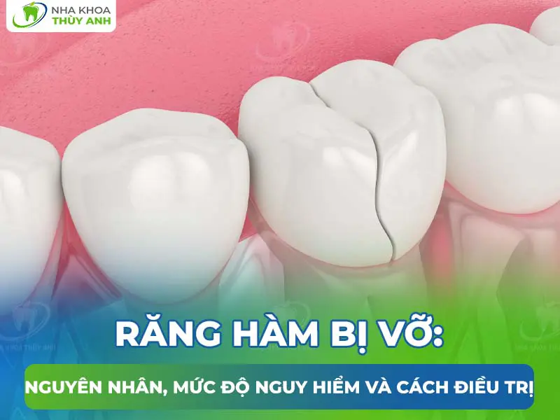 Răng hàm bị vỡ: Nguyên nhân, mức độ nguy hiểm và cách điều trị