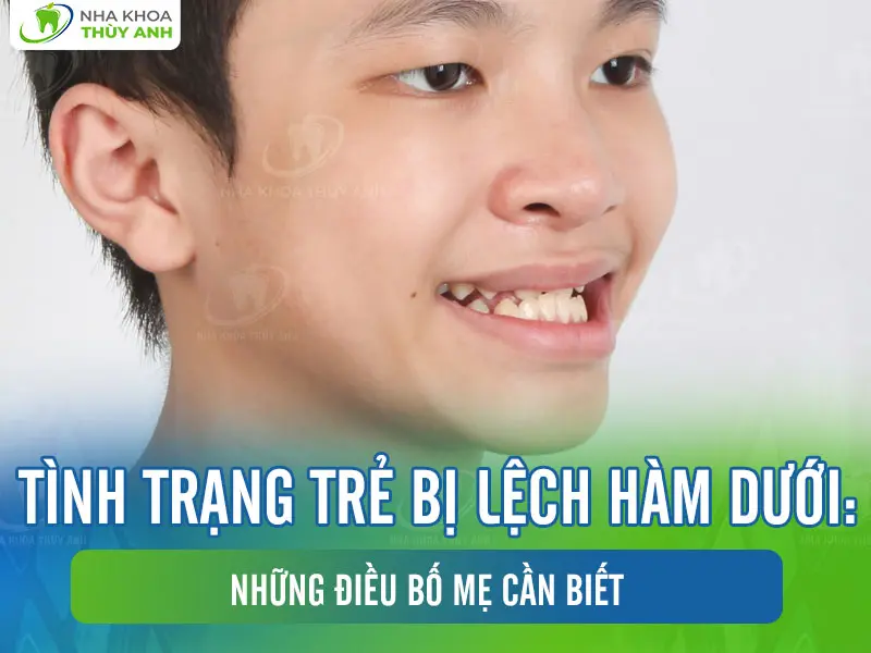 Tình trạng trẻ bị lệch hàm dưới: Những điều bố mẹ cần biết