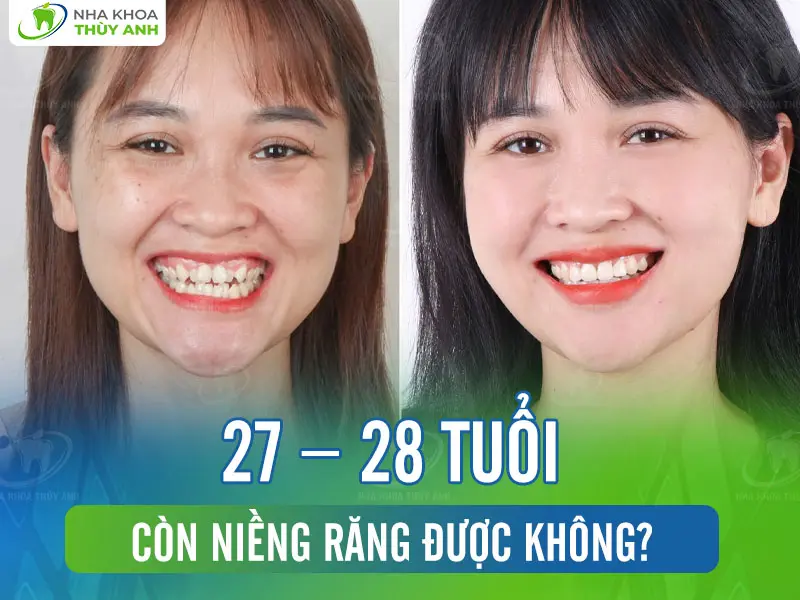 27 – 28 tuổi còn niềng răng được không?