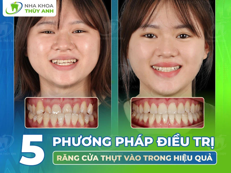 5 phương pháp điều trị răng cửa thụt vào trong hiệu quả