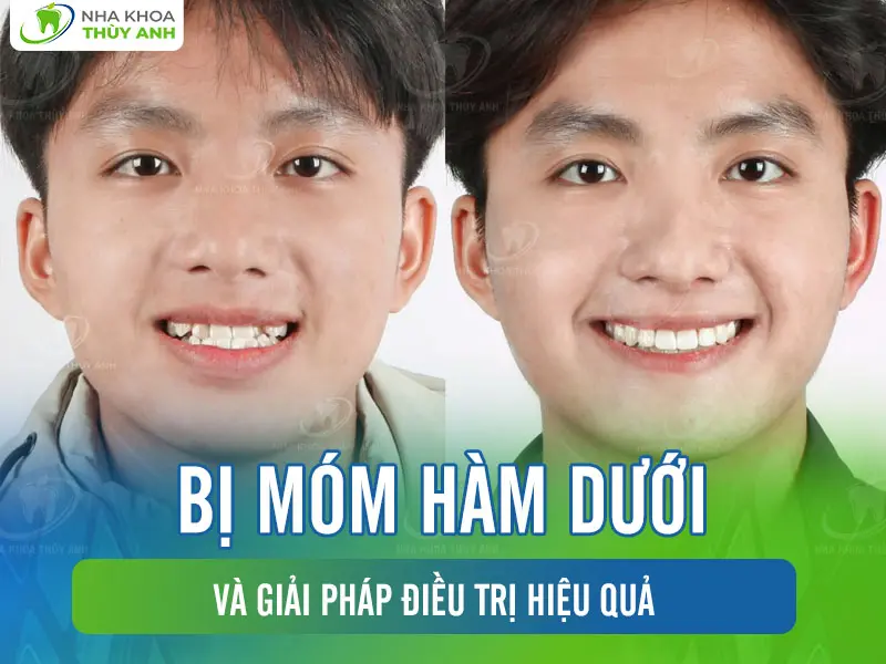 Bị móm hàm dưới và giải pháp điều trị hiệu quả