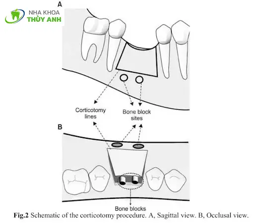 Giải kẹt và tăng tốc chỉnh nha với kỹ thuật chẻ xương vỏ – Corticotomy