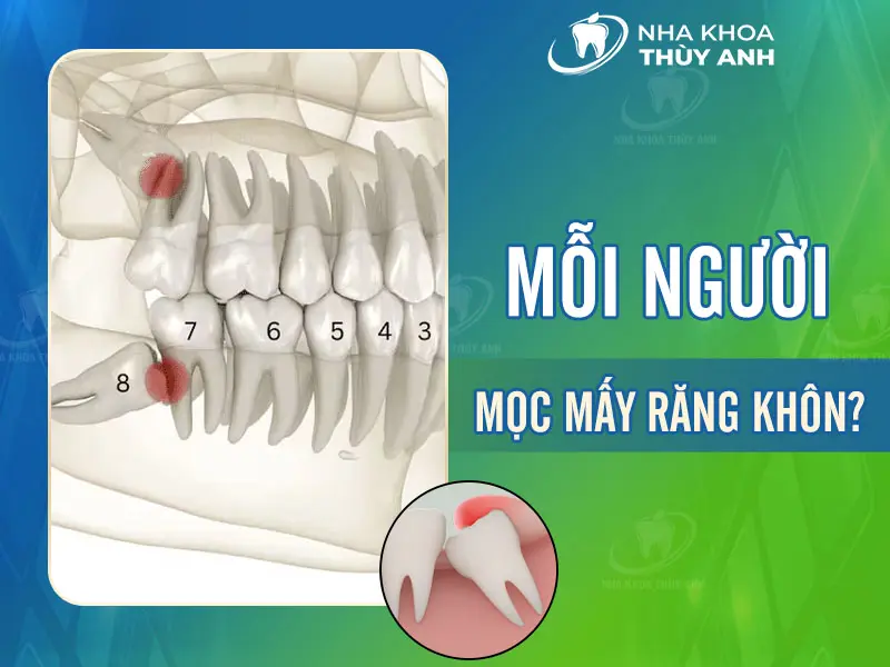 Mỗi người mọc mấy răng khôn?