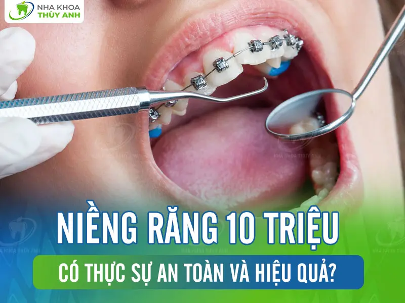 Niềng răng 10 triệu có thực sự an toàn và hiệu quả?