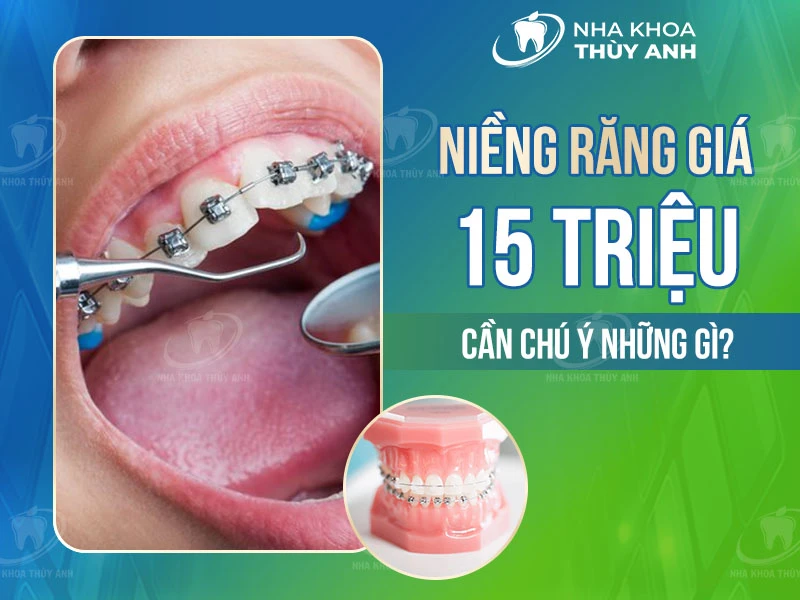 Niềng răng giá 15 triệu cần chú ý những gì?