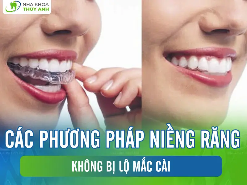 Các phương pháp niềng răng không bị lộ mắc cài