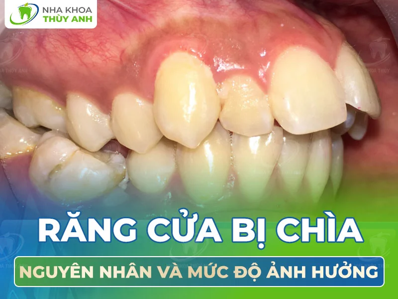 Răng cửa bị chìa: Nguyên nhân và mức độ ảnh hưởng