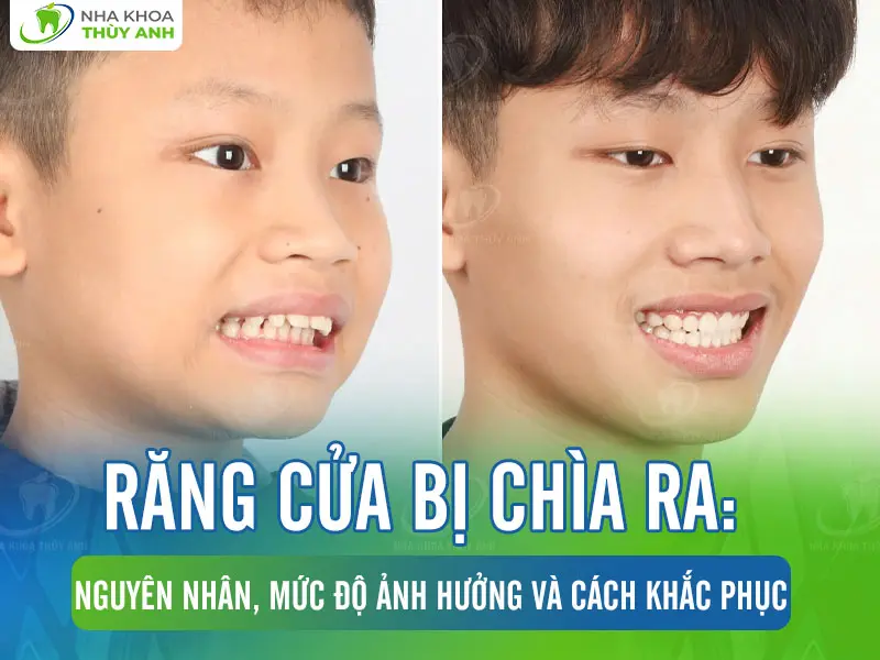 Răng cửa bị chìa ra: Nguyên nhân, mức độ ảnh hưởng và cách khắc phục