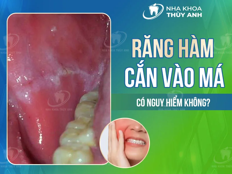 Răng hàm cắn vào má có nguy hiểm không?