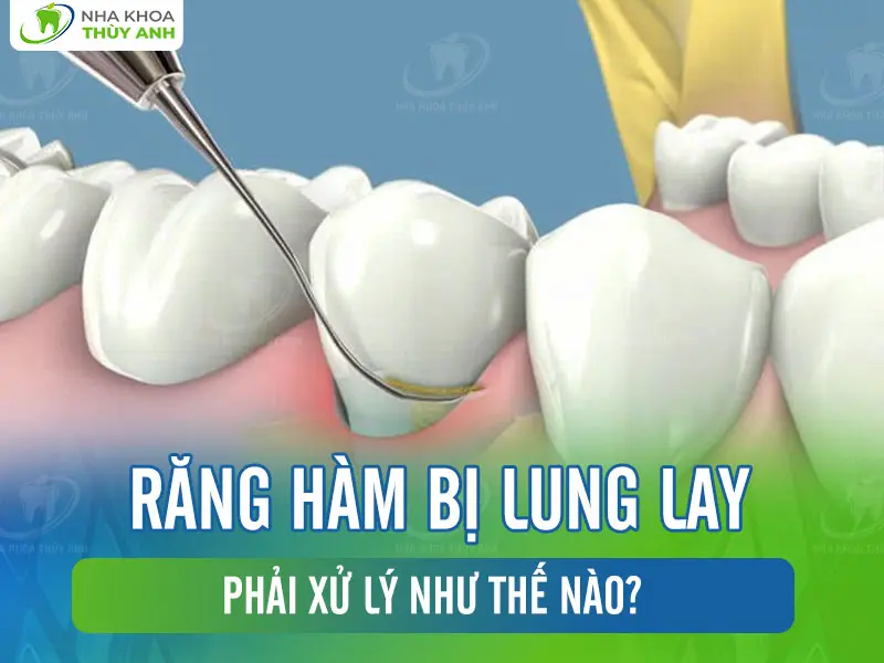 Răng hàm bị lung lay phải xử lý như thế nào?