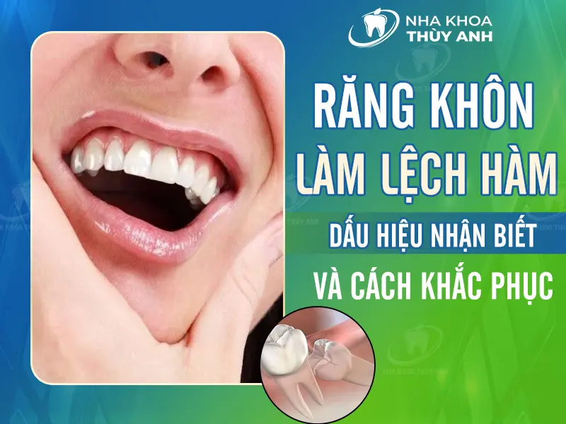 Răng khôn làm lệch hàm: Dấu hiệu nhận biết và cách khắc phục