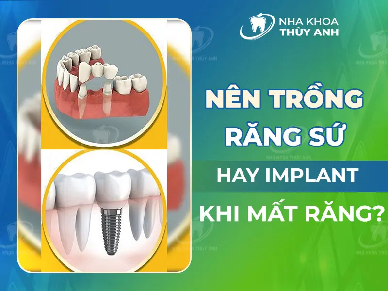 Nên trồng răng sứ hay implant khi mất răng?