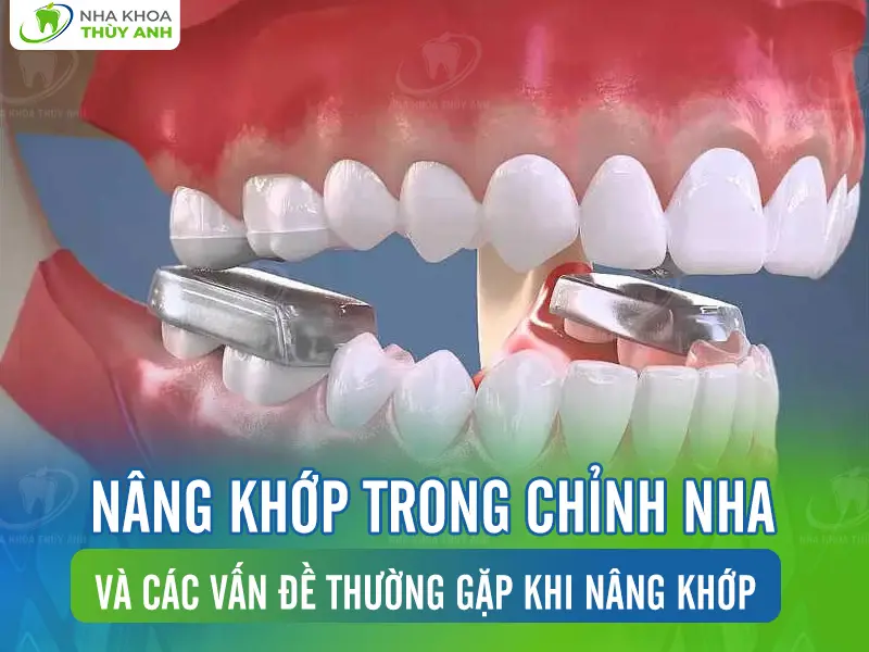 Nâng khớp trong chỉnh nha và các vấn đề thường gặp khi nâng khớp