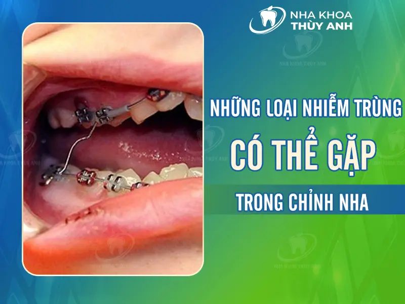 Những loại nhiễm trùng có thể gặp trong chỉnh nha