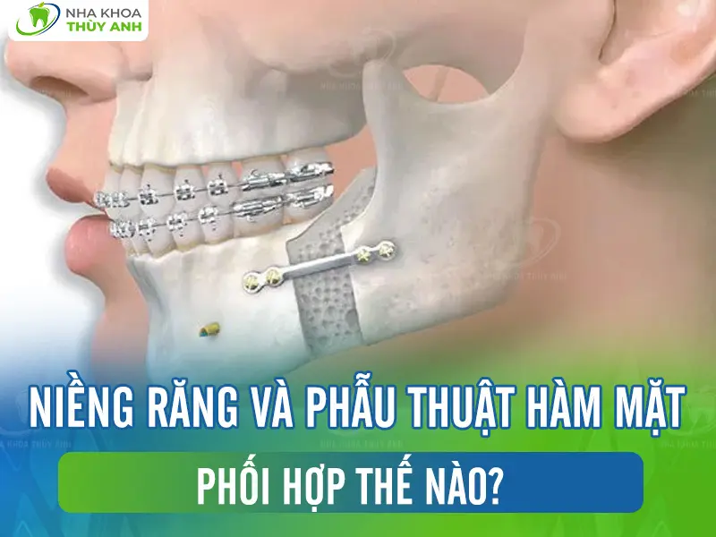 Niềng răng và phẫu thuật hàm mặt phối hợp thế nào?