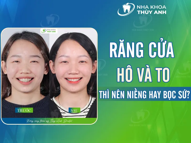 Răng cửa hô và to thì nên niềng hay bọc sứ?