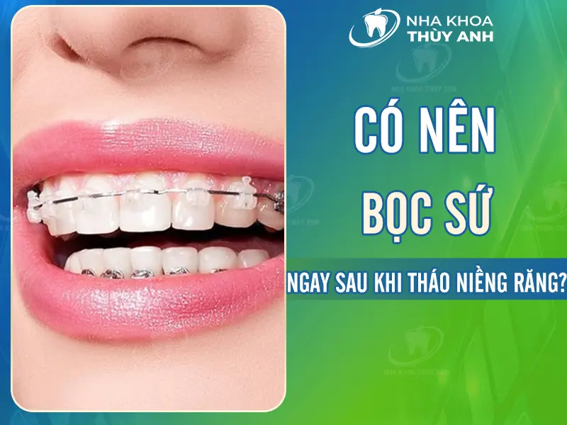 Có nên bọc sứ ngay sau khi tháo niềng răng?