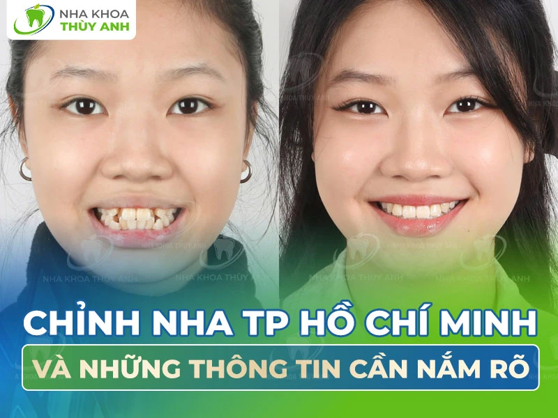 Chỉnh nha HCM và những thông tin cần nắm rõ 