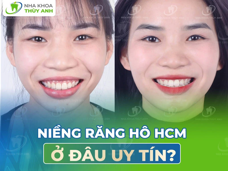 Niềng răng hô HCM ở đâu uy tín?