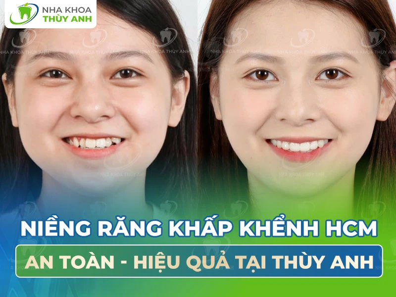 Niềng răng khấp khểnh HCM an toàn hiệu quả tại Thùy Anh