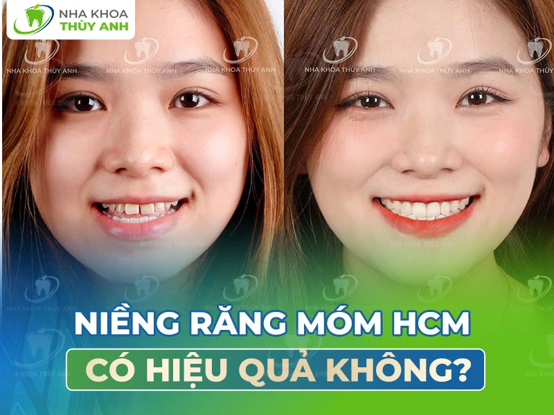 Niềng răng móm HCM có hiệu quả không?