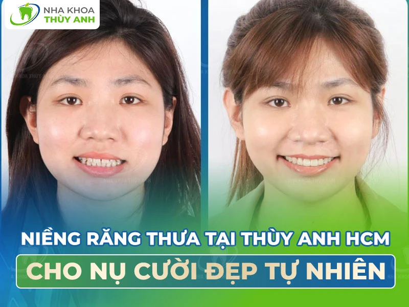 Niềng răng thưa tại Thùy Anh HCM cho nụ cười đẹp tự nhiên