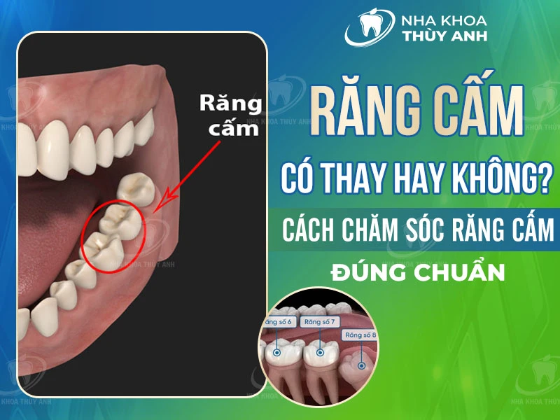 Răng cấm có thay không? Cách chăm sóc răng cấm đúng chuẩn