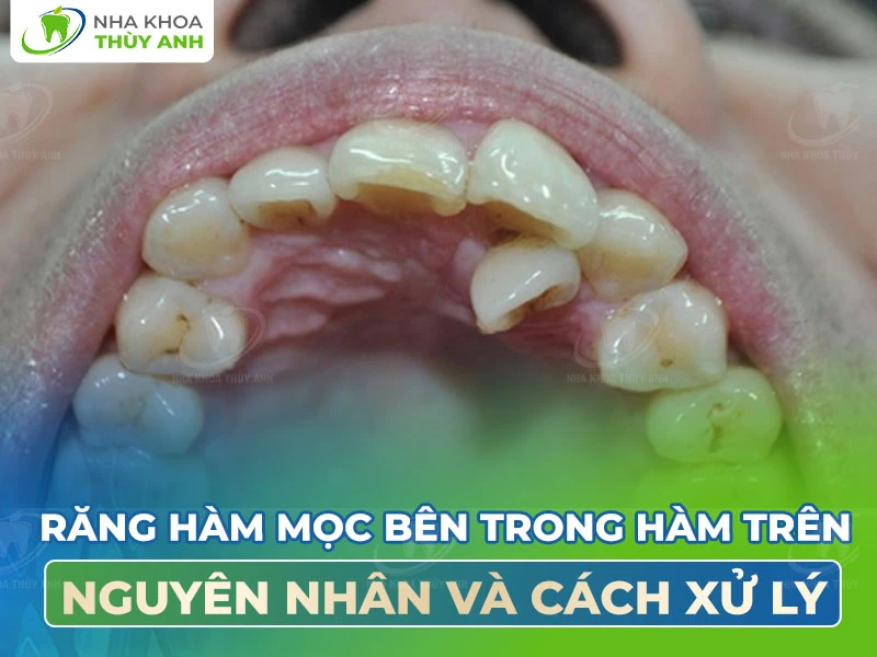 Răng mọc bên trong hàm trên: Nguyên nhân và cách xử lý