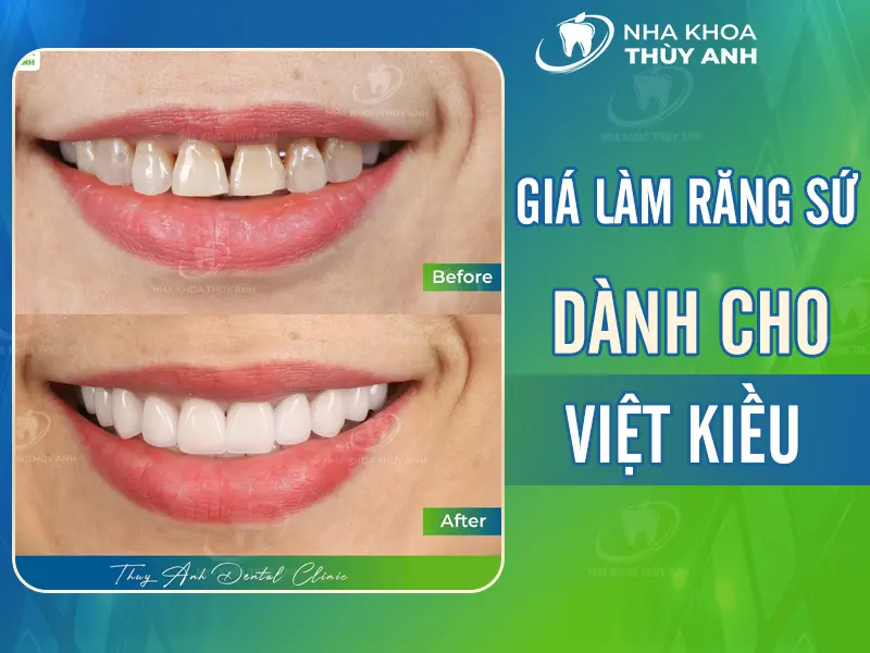 Giá làm răng sứ dành cho Việt Kiều