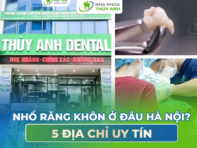 Nhổ răng khôn ở đâu Hà Nội? 5 địa chỉ uy tín