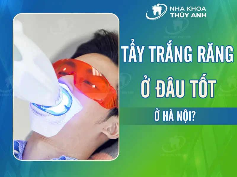 Tẩy trắng răng ở đâu tốt tại Hà Nội?