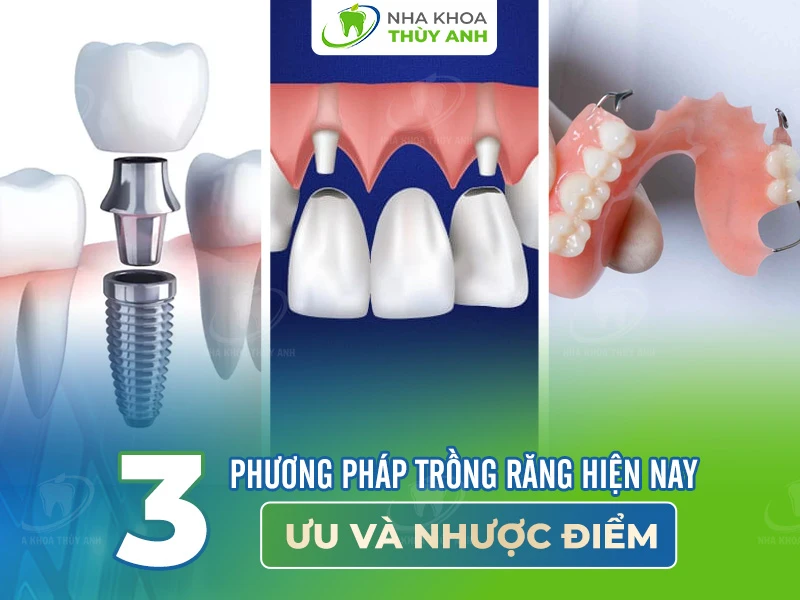 3 phương pháp trồng răng hiện nay: Ưu và nhược điểm
