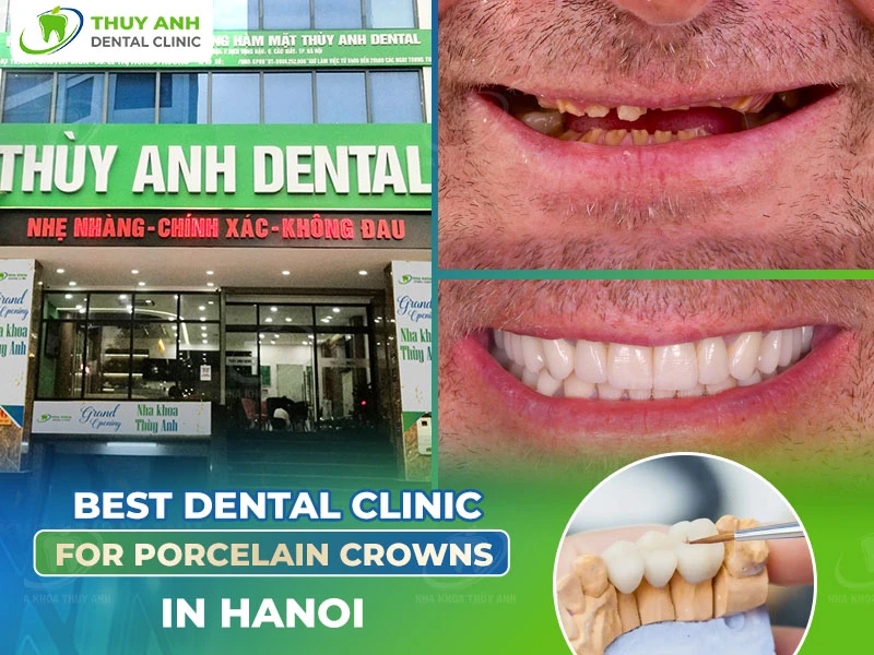 Best Dental Clinic for Porcelain Crowns in Hanoi