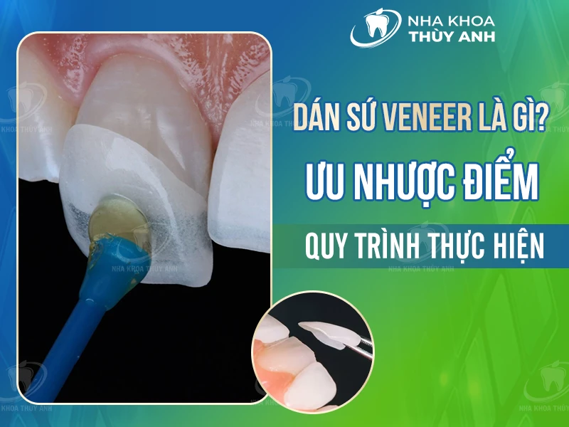 Dán sứ veneer là gì? Ưu nhược điểm và quy trình thực hiện