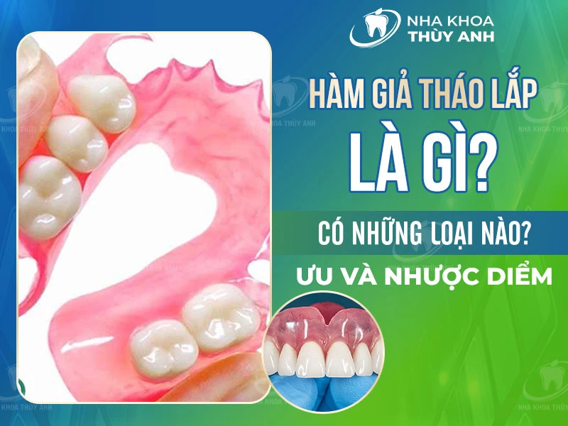 Hàm giả tháo lắp là gì? Có những loại nào? Ưu và nhược điểm