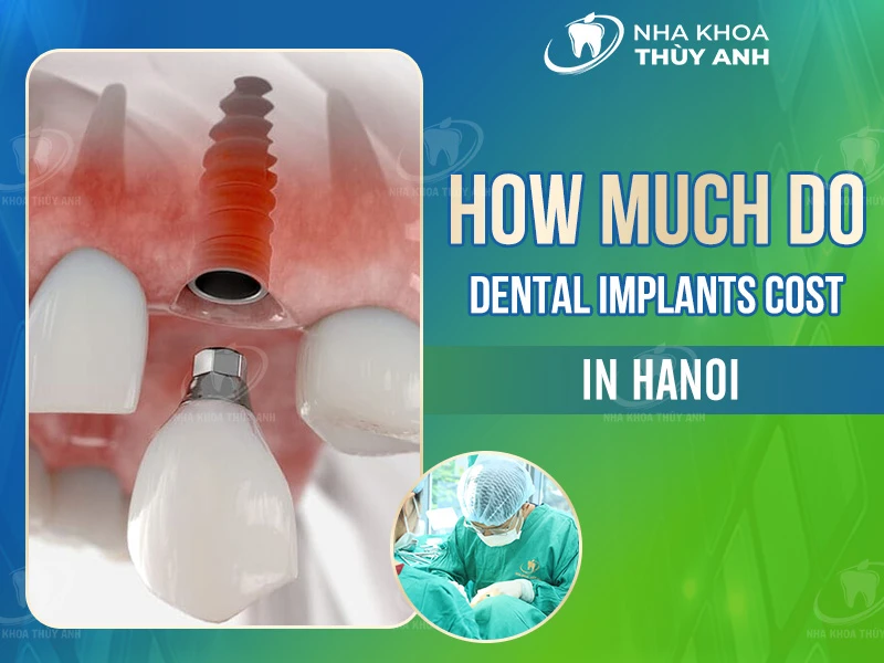 How Much Do Dental Implants Cost in Hanoi?