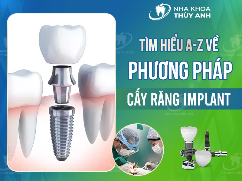 Tìm hiểu từ A-Z về phương pháp cấy răng Implant