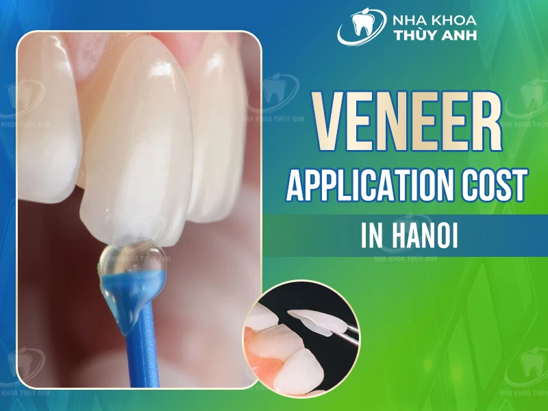 Veneer Application Costs in Hanoi