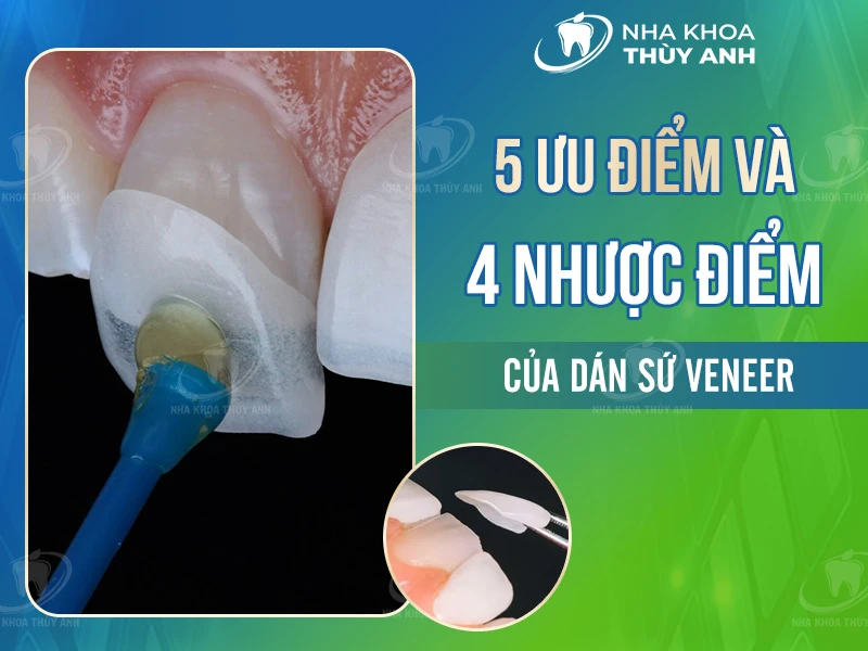 5 Ưu điểm và 4 nhược điểm của dán sứ veneer
