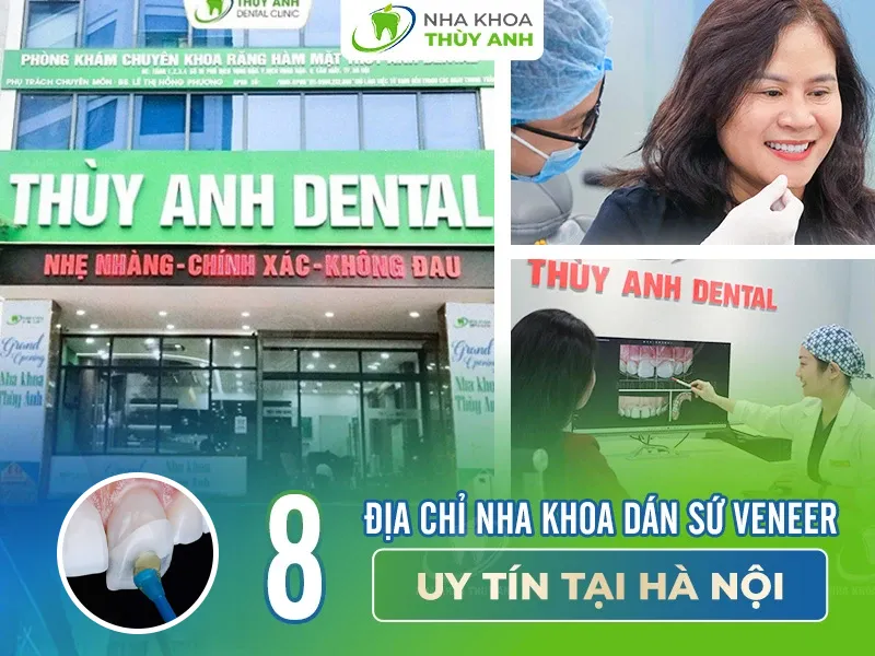 8 địa chỉ nha khoa dán sứ veneer uy tín tại Hà Nội
