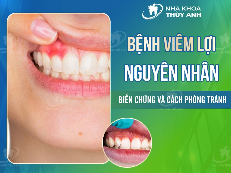Bệnh viêm lợi: Nguyên nhân, biến chứng và cách phòng tránh