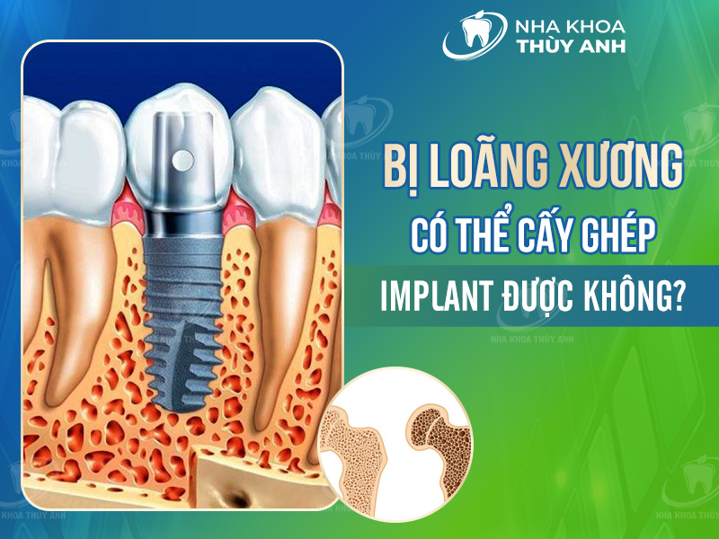 Bị loãng xương có thể cấy ghép implant được không?