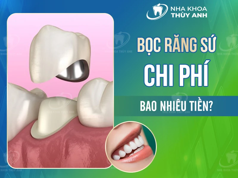 Bọc răng sứ chi phí bao nhiêu tiền? [Tháng 9/2025]