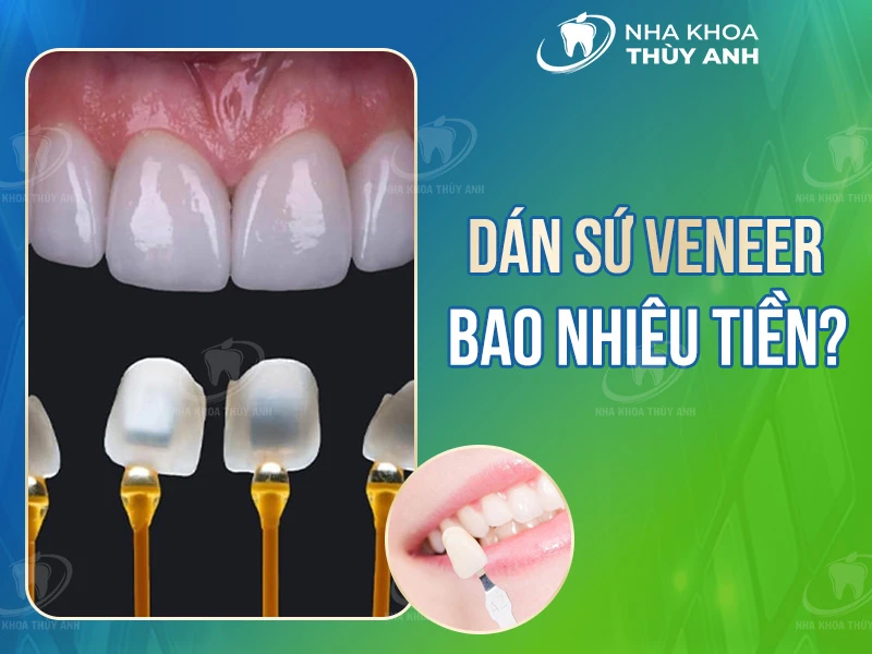 Dán răng sứ veneer bao nhiêu tiền?[Tháng 9.2025]