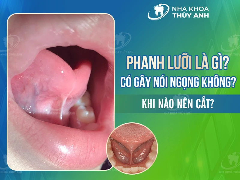 Phanh lưỡi là gì? Có gây nói ngọng không? Khi nào nên cắt?