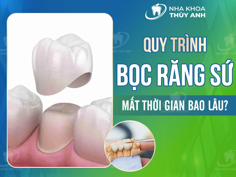 Quy trình bọc răng sứ mất thời gian bao lâu?