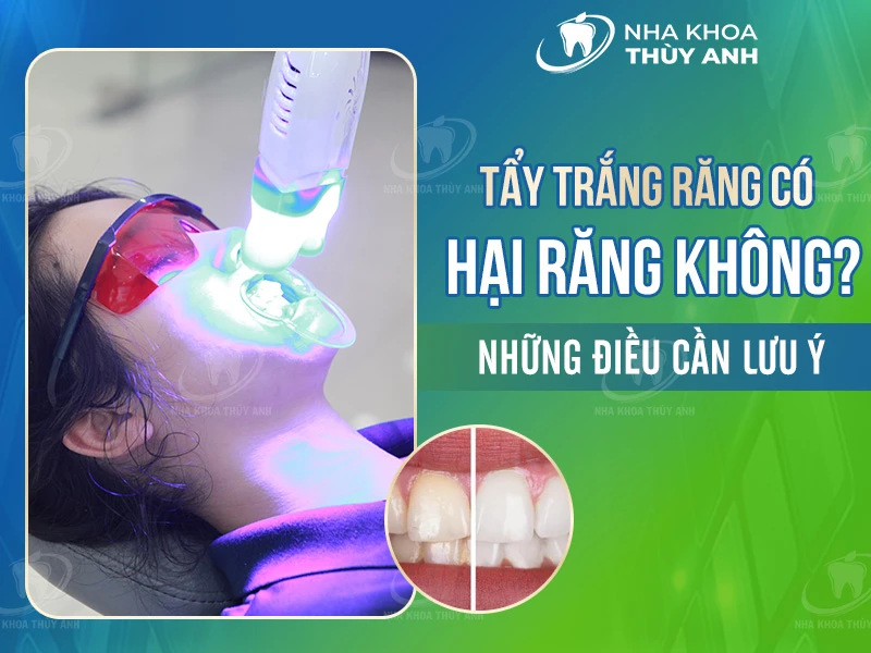Tẩy trắng răng có hại răng không? Những điều cần lưu ý