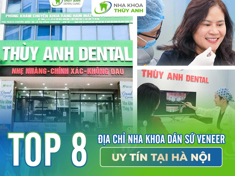 Top 8 địa chỉ nha khoa dán sứ veneer uy tín tại Hà Nội