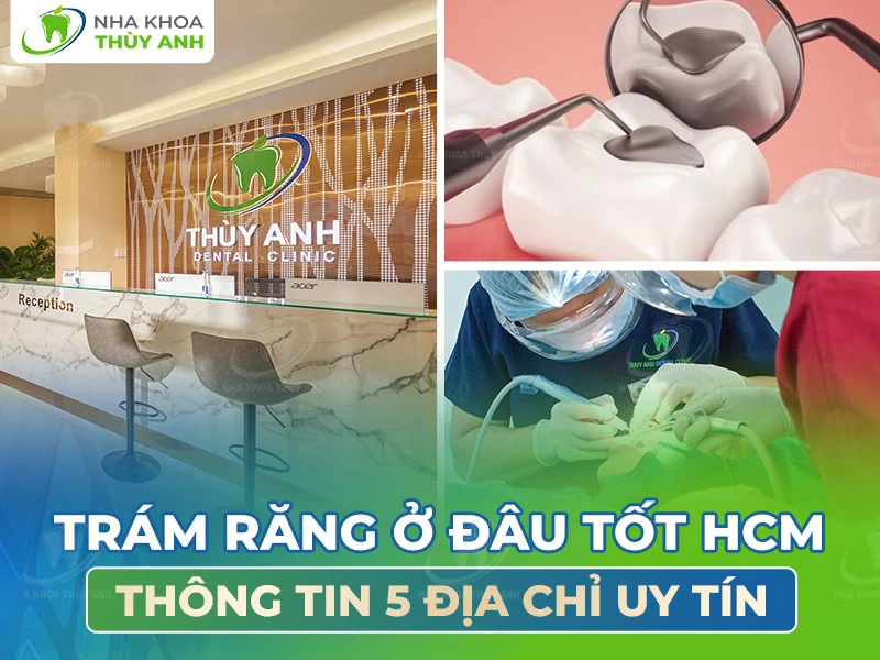 Trám răng ở đâu tốt HCM? Thông tin 5 địa chỉ uy tín